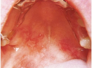 Ağız İçi Yanak Yarası Belirtileri ve Tedavisi